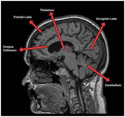 Vision transformers for the prediction of mild cognitive impairment to Alzheimer’s disease progression using mid-sagittal sMRI